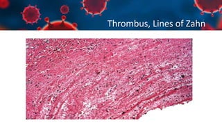 Thrombus, Lines of Zahn
 