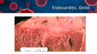 Endocarditic, Gross
 