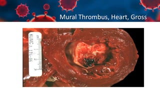 Mural Thrombus, Heart, Gross
 