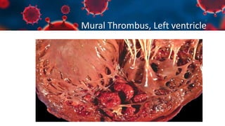Mural Thrombus, Left ventricle
 