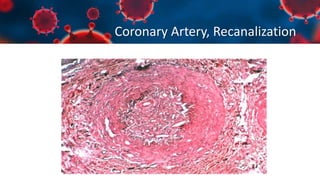 Coronary Artery, Recanalization
 