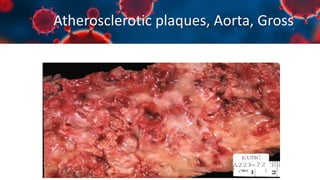 Atherosclerotic plaques, Aorta, Gross
 