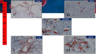 LUNG BRAIN
KIDNEY
LIVER
PANCREAS
S
U
D
A
N
III
S
T
A
I
N
 