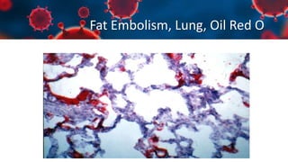 Fat Embolism, Lung, Oil Red O
 