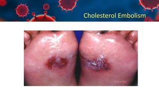 Cholesterol Embolism
 