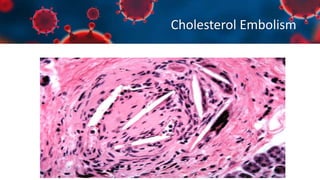 Cholesterol Embolism
 