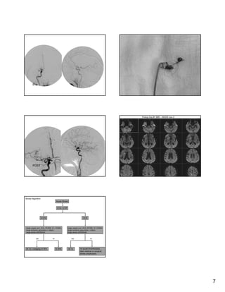 Thrombolytic  Therapy For  Acute  Stroke