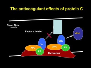 VIIIai
The anticoagulant effects of protein C
Blood Flow
VIIIa
Va
Thrombus
Vai
APC
APC
PS
PS
Factor V Leiden
 