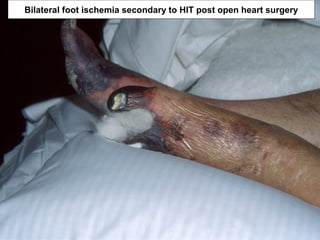 Bilateral foot ischemia secondary to HIT post open heart surgery
 