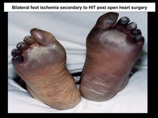 Bilateral foot ischemia secondary to HIT post open heart surgery
 