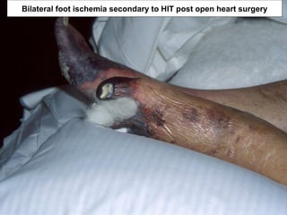 Bilateral foot ischemia secondary to HIT post open heart surgery
 