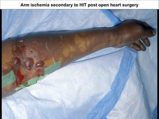 Arm ischemia secondary to HIT post open heart surgery
 