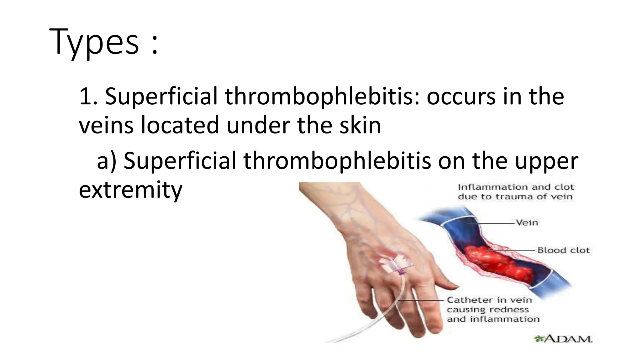 THROMBOPHLEBITIS.pptx