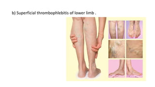 b) Superficial thrombophlebitis of lower limb .
 