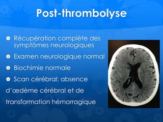 Post-thrombolyse
 Récupération complète des
symptômes neurologiques
 Examen neurologique normal
 Biochimie normale
 Scan cérébral: absence
d’œdème cérébral et de
transformation hémorragique
 