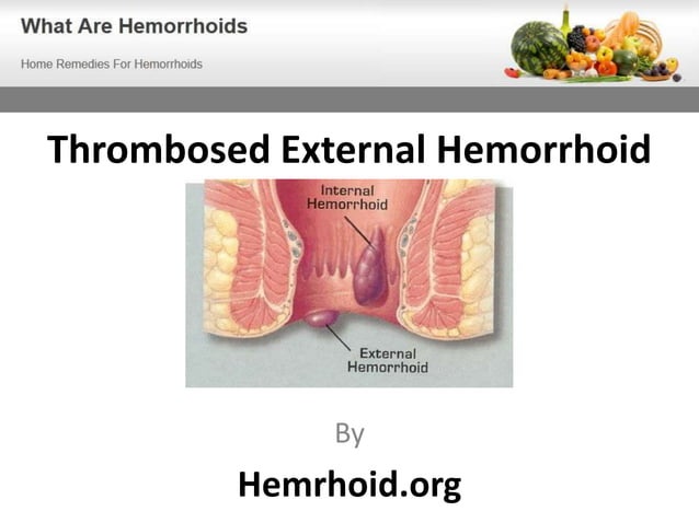 thrombosed-external-hemorrhoid-pptx-digestive-disorders-diseases