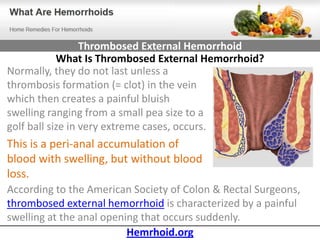 Thrombosed External Hemorrhoid
            What Is Thrombosed External Hemorrhoid?
Normally, they do not last unless a
thrombosis formation (= clot) in the vein
which then creates a painful bluish
swelling ranging from a small pea size to a
golf ball size in very extreme cases, occurs.
This is a peri-anal accumulation of
blood with swelling, but without blood
loss.
According to the American Society of Colon & Rectal Surgeons,
thrombosed external hemorrhoid is characterized by a painful
swelling at the anal opening that occurs suddenly.
                          Hemrhoid.org
 