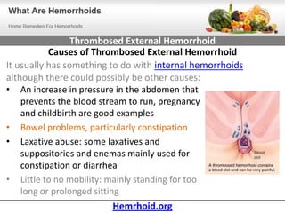 Thrombosed External Hemorrhoid
           Causes of Thrombosed External Hemorrhoid
It usually has something to do with internal hemorrhoids
although there could possibly be other causes:
• An increase in pressure in the abdomen that
    prevents the blood stream to run, pregnancy
    and childbirth are good examples
• Bowel problems, particularly constipation
• Laxative abuse: some laxatives and
    suppositories and enemas mainly used for
    constipation or diarrhea
• Little to no mobility: mainly standing for too
    long or prolonged sitting
                            Hemrhoid.org
 