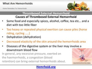 Thrombosed External Hemorrhoid
            Causes of Thrombosed External Hemorrhoid
• Some food and especially spices, alcohol, coffee, tea etc… and a
    diet with too little fiber
• Too heavy or repeated physical exertion can cause piles (horse
    riding, cycling …..)
• Dehydration (dehydration)
• Decreased elasticity of the skin around the hemorrhoids area
• Diseases of the digestive system or the liver may involve a
    downstream blood flow
In general, any excessive pressure, exerted on
the haemorrhoids, a congestion (blood
retention) can bring external hemorrhoids about.
                          Hemrhoid.org
 