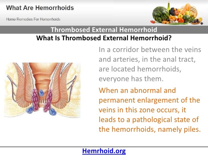 Thrombosed External Hemorrhoid