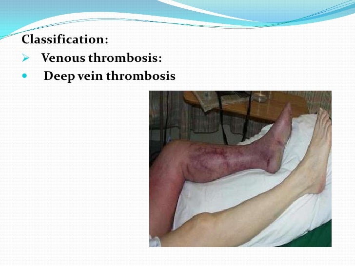 Thrombosis