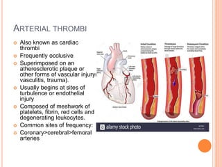 ARTERIAL THROMBI
 Also known as cardiac
thrombi
 Frequently occlusive
 Superimposed on an
atherosclerotic plaque or
other forms of vascular injury(
vasculitis, trauma).
 Usually begins at sites of
turbulence or endothelial
injury
 Composed of meshwork of
platelets, fibrin, red cells and
degenerating leukocytes.
 Common sites of frequency:
 Coronary>cerebral>femoral
arteries
 