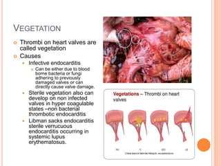 VEGETATION
 Thrombi on heart valves are
called vegetation
 Causes
 Infective endocarditis
 Can be either due to blood
borne bacteria or fungi
adhering to previously
damaged valves or can
directly cause valve damage.
 Sterile vegetation also can
develop on non infected
valves in hyper coagulable
states –non bacterial
thrombotic endocarditis
 Libman sacks endocarditis
sterile verrucuous
endocarditis occurring in
systemic lupus
erythematosus.
 