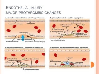 ENDOTHELIAL INJURY
MAJOR PROTHROMBIC CHANGES
 