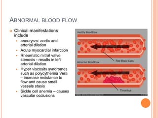 ABNORMAL BLOOD FLOW
 Clinical manifestations
include
 aneurysm- aortic and
arterial dilation
 Acute myocardial infarction
 Rheumatic mitral valve
stenosis - results in left
arterial dilation
 Hyper viscosity syndromes
such as polycythemia Vera
– increase resistance to
flow and cause small
vessels stasis
 Sickle cell anemia – causes
vascular occlusions
 