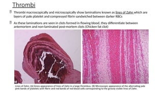  Thrombi macroscopically and microscopically show laminations known as lines of Zahn which are
layers of pale platelet and compressed fibrin sandwiched between darker RBCs
 As these laminations are seen in clots formed in flowing blood, they differentiate between
antemortem and non-laminated post-mortem clots (Chicken fat clot)
Thrombi
 