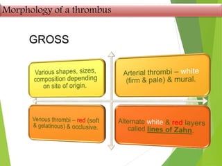 Morphology of a thrombus
GROSS
 