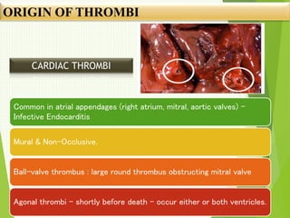 ORIGIN OF THROMBI
Common in atrial appendages (right atrium, mitral, aortic valves) –
Infective Endocarditis
Mural & Non-Occlusive.
Ball-valve thrombus : large round thrombus obstructing mitral valve
Agonal thrombi – shortly before death – occur either or both ventricles.
CARDIAC THROMBI
 