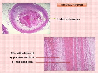 Occlusive thrombus
Alternating layers of
a) platelets and fibrin
b) red blood cells
ARTERIAL THROMBI
 