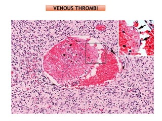 VENOUS THROMBI
 
