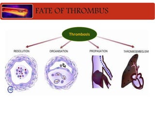 FATE OF THROMBUS
Thrombosis
 