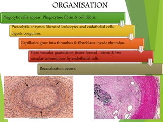 ORGANISATION
Phagocytic cells appear. Phagocytose fibrin & cell debris.
Proteolytic enzymes liberated leukocytes and endothelial cells,
digests coagulum.
Capillaries grow into thrombus & fibroblasts invade thrombus.
Fibro vascular granulation tissue formed , dense & less
vascular covered over by endothelial cells.
Recanalisation occurs.
 