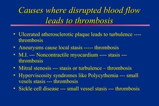 Causes where disrupted blood flow
Causes where disrupted blood flow
leads to thrombosis
leads to thrombosis
• Ulcerated atherosclerotic plaque leads to turbulence ----
thrombosis
• Aneurysms cause local stasis ----- thrombosis
• M.I. --- Noncontractile myocardium ---- stasis ---
thrombosis
• Mitral stenosis --- stasis or turbulence – thrombosis
• Hyperviscosity syndromes like Polycythemia --- small
vesels stasis --- thrombosis
• Sickle cell disease --- small vessel stasis --- thrombosis
 