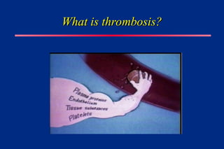 What is thrombosis?
What is thrombosis?
 