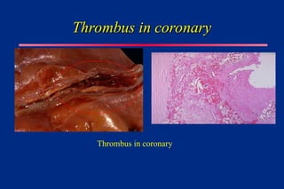 Thrombus in coronary
Thrombus in coronary
Thrombus in coronary
 