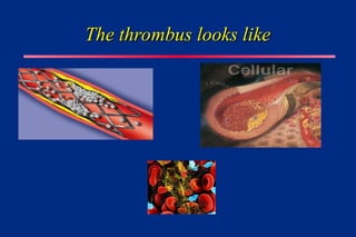 The thrombus looks like
The thrombus looks like
 