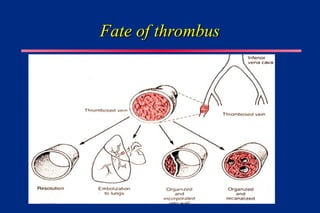 Fate of thrombus
Fate of thrombus
 