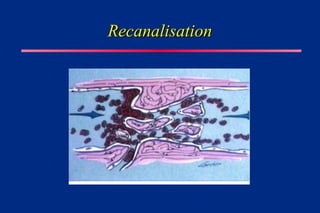Recanalisation
Recanalisation
 