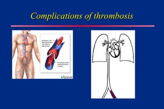 Complications of thrombosis
Complications of thrombosis
 