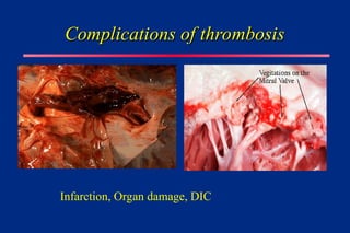 Complications of thrombosis
Complications of thrombosis
Infarction, Organ damage, DIC
 