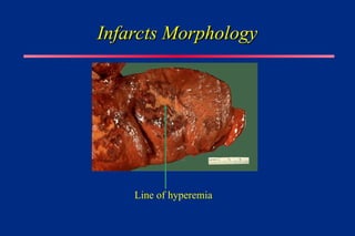 Infarcts Morphology
Infarcts Morphology
Line of hyperemia
 