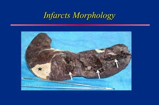 Infarcts Morphology
Infarcts Morphology
 