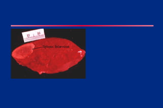 Hemodynamics including thrombosis lecture