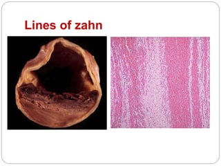 Lines of zahn
 