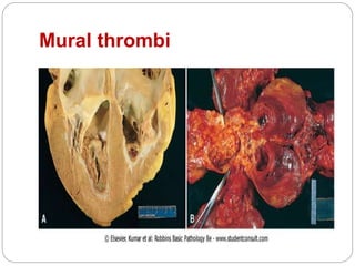 Mural thrombi
 