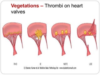 Vegetations – Thrombi on heart
valves
 